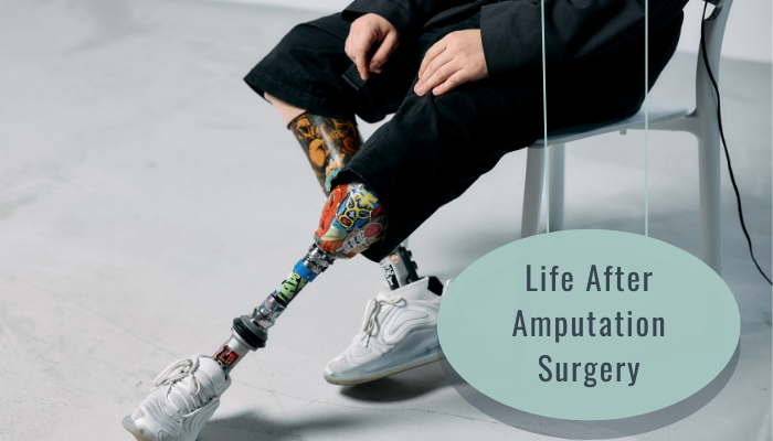 Life After Amputation Surgery